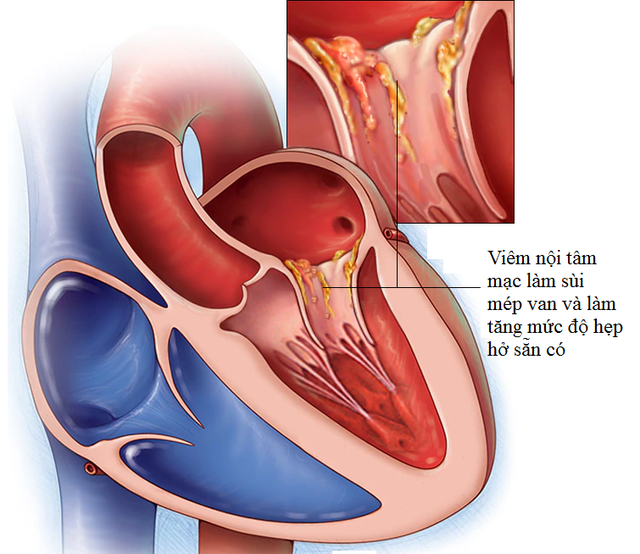 Bs bệnh viện Việt Đức cảnh báo: Khi bị sốt kéo dài, tái phát, rất có thể bạn mắc phải 1 bệnh lý nguy hiểm, không phát hiện kịp thời khó giữ được tính mạng - Ảnh 1.