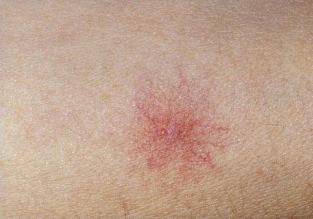 Người đàn ông 35 tuổi nhận thấy 2 dấu hiệu bất thường trên cơ thể, gặp bác sĩ thì bệnh xơ gan đã ở giai đoạn cuối: Đừng vì bận rộn mà bỏ quên tài sản quý giá nhất! - Ảnh 1.