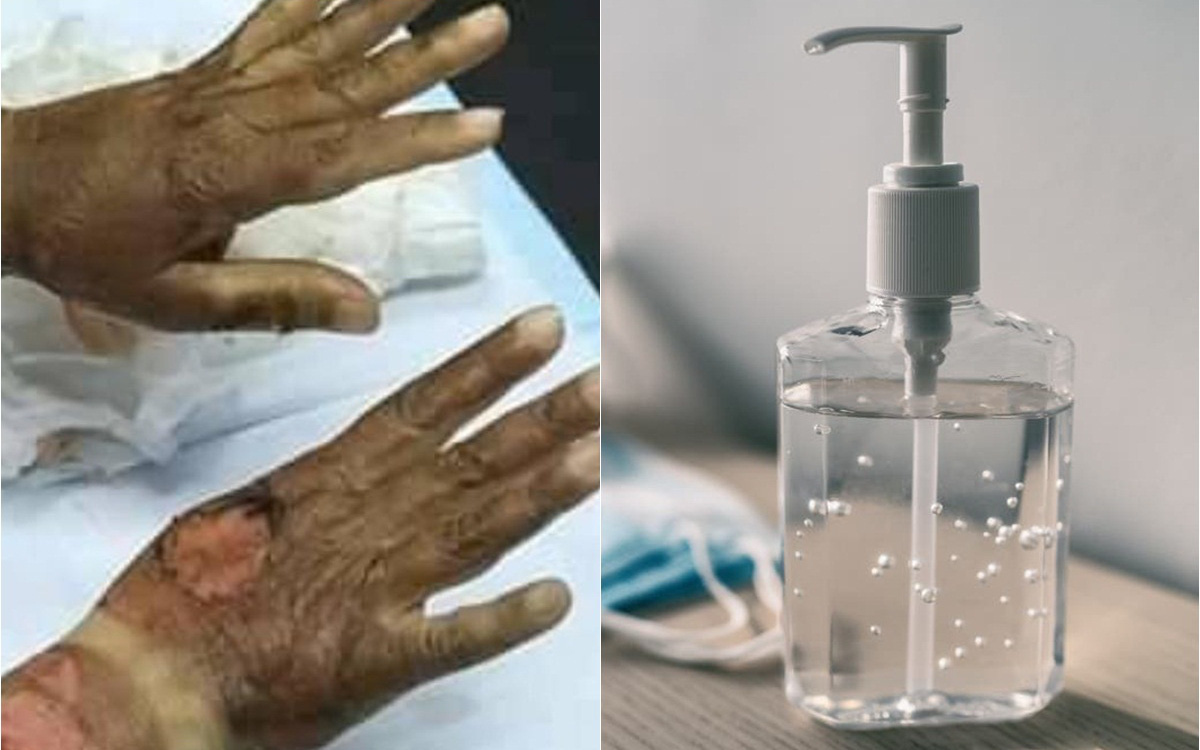 Thực hư chuyện bị bỏng vì cồn sót lại trên da sau khi dùng nước rửa tay khô và những điều cần chú ý để rửa tay an toàn trong mùa dịch Covid-19