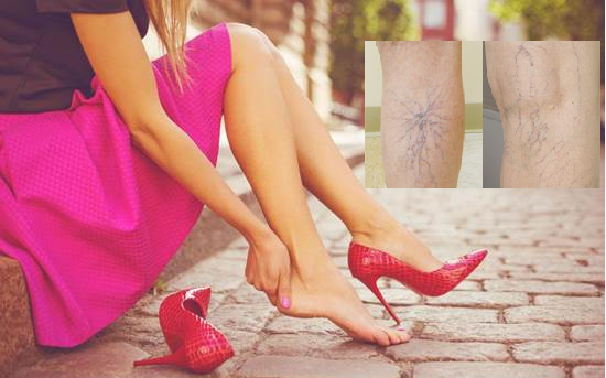 Bác sĩ BV Việt Đức cảnh báo căn bệnh khiến &quot;tê chân, chuột rút về chiều&quot;: Phụ nữ thường đi giày cao gót cần hết sức lưu ý