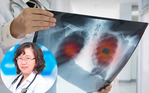 Cứ 10 người bị ung thư phổi, sau 5 năm chỉ 1-2 người còn sống: Bác sĩ chuyên khoa Hô hấp &quot;điểm danh&quot; những đối tượng nên tầm soát căn bệnh nguy hiểm này định kỳ