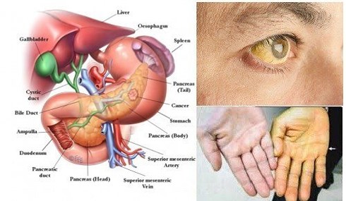 Người đàn ông 50 tuổi, thể lực tốt bỗng phát hiện ngay khối u tuyến tụy: Đừng chủ quan khi thấy cơ thể có dấu hiệu này! - Ảnh 1.