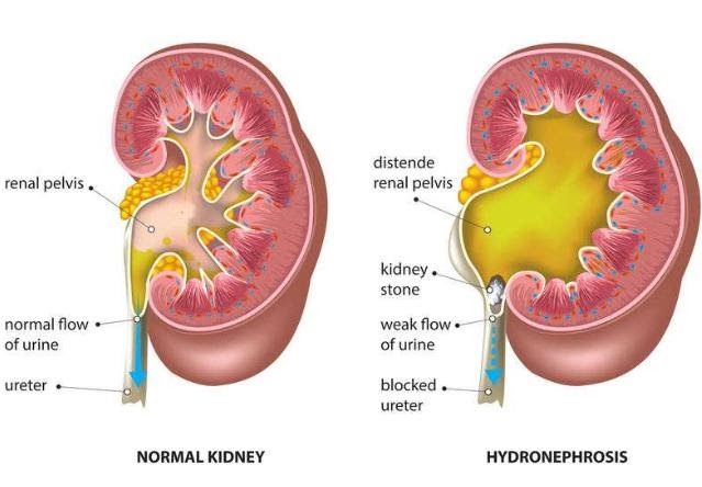 3 thói quen tiêu thụ nước kinh điển khiến thận hư thận yếu: Cực nhiều người mắc phải nhưng không muốn thận toàn sỏi thì phải tỉnh táo mà từ bỏ ngay - Ảnh 3.