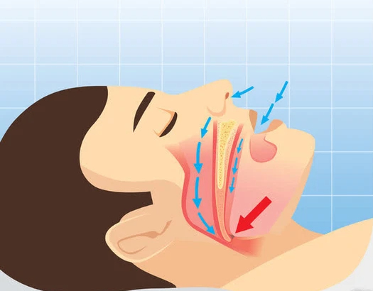 Khi ngủ, ngáy to là dấu hiệu ngủ ngon hay do bệnh? Bác sĩ nhắc nhở có một loại ngủ ngáy là bệnh nguy hiểm, biết sớm để điều trị kẻo đột tử lúc nào chẳng hay - Ảnh 1.