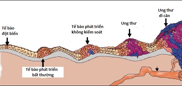 Cô gái 27 tuổi phát hiện ung thư phổi ác tính: Không hút thuốc, không uống rượu, cứ ngỡ mình sống lành mạnh nhưng cuối cùng phải cắt bỏ cả thùy phổi - Ảnh 1.