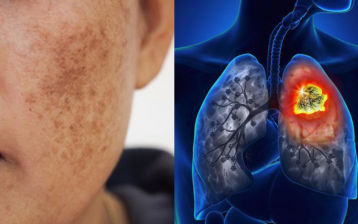 ''2 đỏ 3 đen'' ở các vùng này trên cơ thể tiết lộ phổi lâm nguy, nhiều người không biết sớm dẫn đến phải làm bạn với máy thở