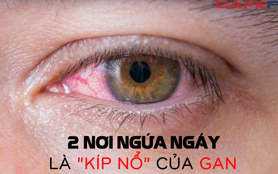 2 nơi ngứa ngáy là &quot;kíp nổ&quot; của gan: Tuân thủ 3 điều kiêng, 1 việc siêng mỗi ngày để bổ gan giải độc, dưỡng sinh khí