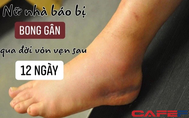 Nữ nhà báo bị bong gân chân, qua đời vỏn vẹn sau 12 ngày vì thuyên tắc phổi: Cứ ngỡ chẳng liên quan, nhưng sự chủ quan đã cướp đi mạng sống của cô gái theo cách mà ai cũng có thể mắc phải