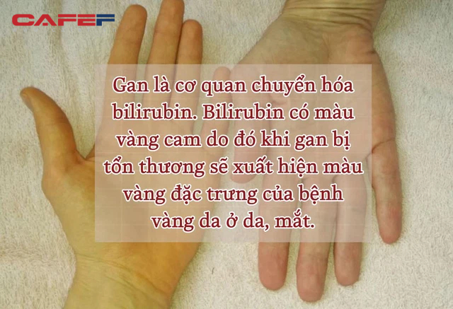 Da chuyển vàng và 3 biểu hiện sau là dấu hiệu sớm của ung thư gan: Có chỉ dù 1 cũng nên kiểm tra ngay để không bị tử thần đoạt mạng - Ảnh 2.