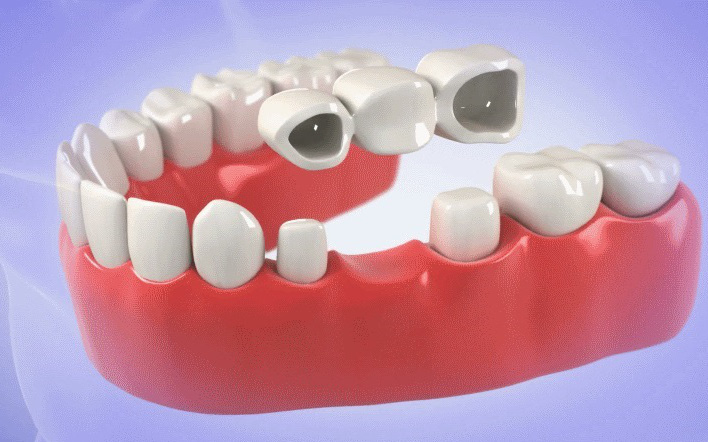 Mất răng nên trồng răng Implant hay làm cầu răng sứ?