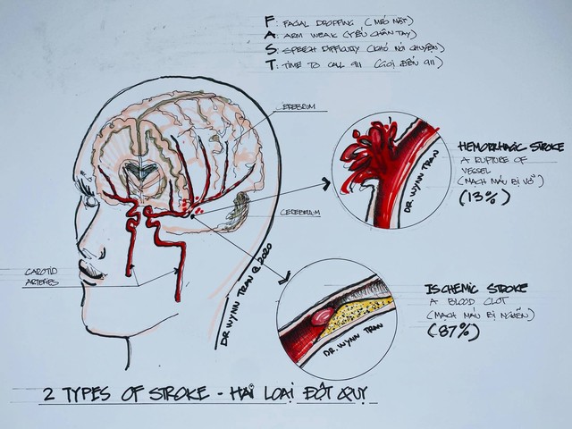 Đột quỵ não không chừa 1 ai: Bác sĩ Việt tại Mỹ chỉ ra cách để ngăn ngừa căn bệnh nguy hiểm này - Ảnh 1.