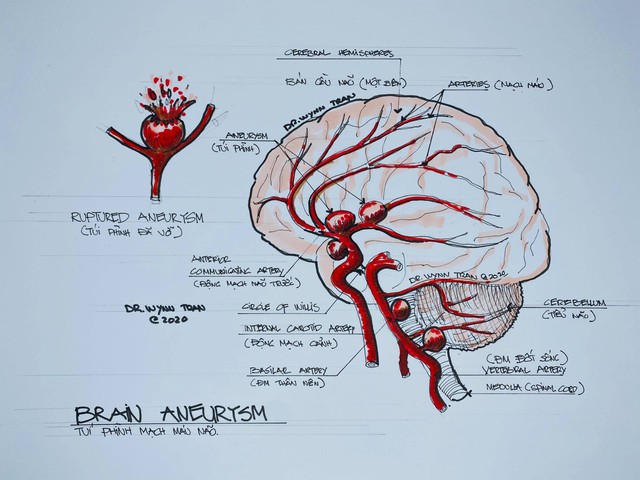 Đột quỵ não không chừa 1 ai: Bác sĩ Việt tại Mỹ chỉ ra cách để ngăn ngừa căn bệnh nguy hiểm này - Ảnh 2.