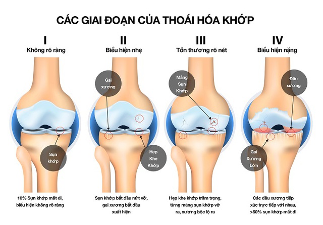 Bác sĩ BV Việt Đức cảnh báo căn bệnh hơn 23% người trung niên ở Việt Nam đều mắc, không điều trị sớm có thể sinh thêm trầm cảm - Ảnh 4.