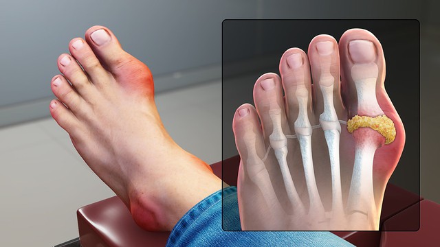 Nếu không thay đổi 4 thói quen này, bệnh gout đến giày vò bạn chỉ là vấn đề thời gian: Các khớp sưng tấy và đau nhức, cơn đau chạy từ ngón chân cái lên các ngón tay - Ảnh 2.