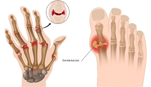 Nếu không thay đổi 4 thói quen này, bệnh gout đến giày vò bạn chỉ là vấn đề thời gian: Các khớp sưng tấy và đau nhức, cơn đau chạy từ ngón chân cái lên các ngón tay - Ảnh 1.