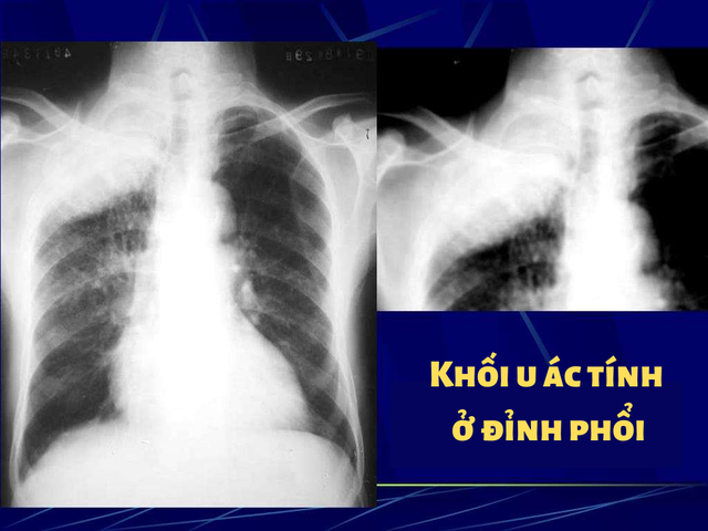 Ngỡ rằng bị đau bả vai thông thường, người đàn ông 55 tuổi bất ngờ bị chẩn đoán ung thư phổi: Dấu hiệu đáng ngạc nhiên cảnh báo ung thư không phải ai cũng biết - Ảnh 2.