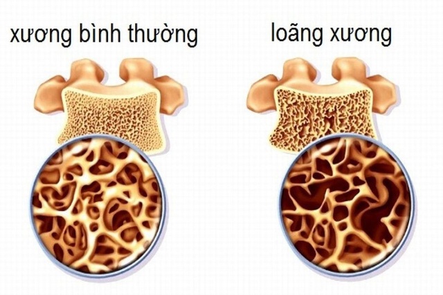 Đồ ngọt và loại thực phẩm này chính là máy “hút cạn canxi” trong cơ thể bạn: Nhiều người không biết vẫn vô tư ăn mỗi ngày, xương và răng yếu đừng hỏi tại sao - Ảnh 4.